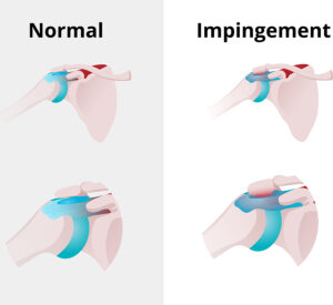 shoulder impingement